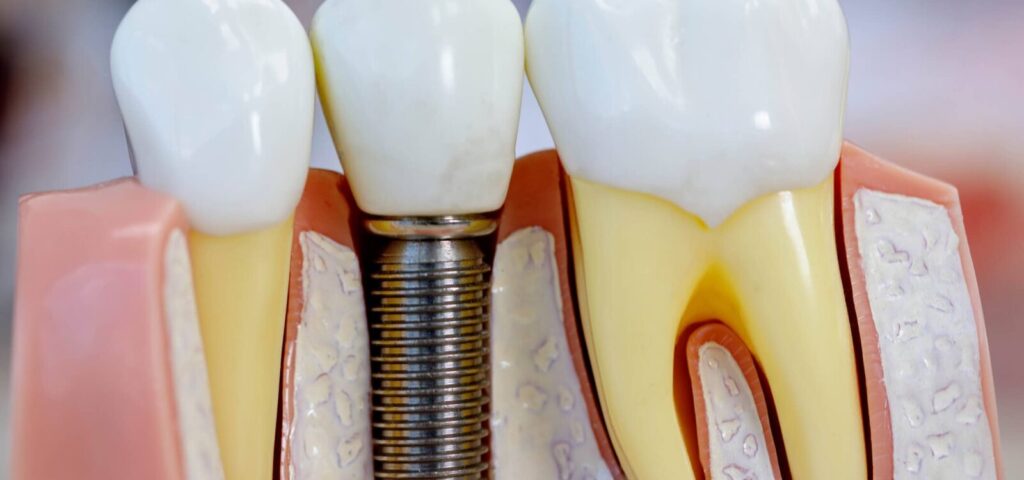 Unicare Asa Sul Brasília Implante Dentario Unicare Asa Sul Brasília Implante Dentario