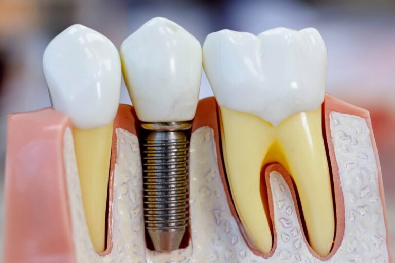 Unicare Asa Sul Brasília Implante Dentario